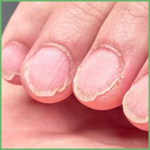 Skin symptoms hypothyroidism